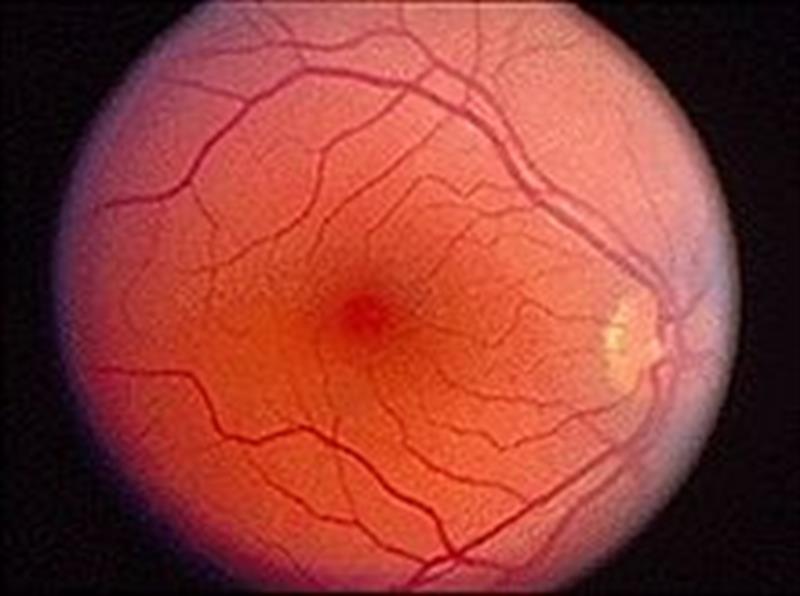 دراسة: شبكية العين تتنبأ بالنوبة القلبية قبل عام بنسبة 80%